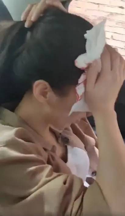 黄圣依受访首谈额头伤势,自曝送院当晚缝了六针,希望不会留疤