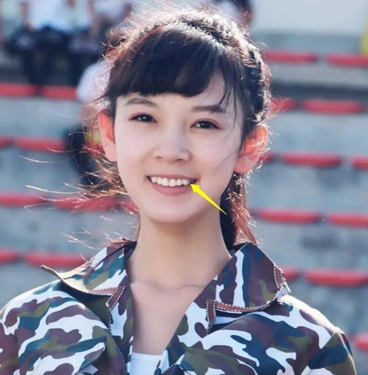 林允陈瑶脸型大变灵气全无,刘涛花300万找罪受,非要整一口假牙何必呢?