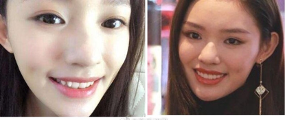 林允陈瑶脸型大变灵气全无,刘涛花300万找罪受,非要整一口假牙何必呢?
