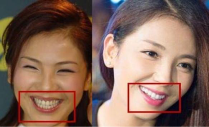 林允陈瑶脸型大变灵气全无,刘涛花300万找罪受,非要整一口假牙何必呢?