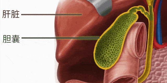 不吃早餐,真的会胆结石吗?