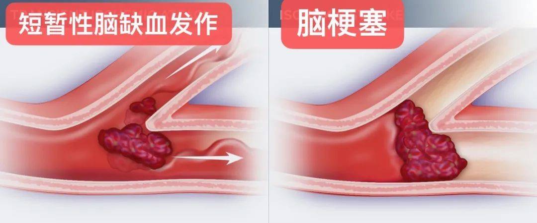 【花资】【转】注意!这个症状是脑中风的重要先兆!