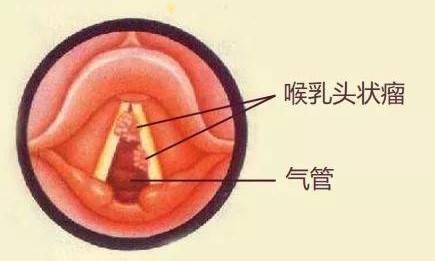 【花资】【转】孕期HPV找上门,会影响胎儿吗?
