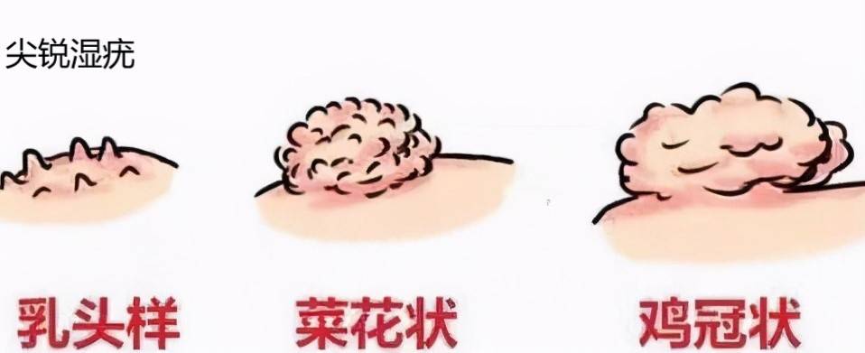 【花资】【转】孕期HPV找上门,会影响胎儿吗?