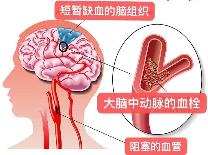 【花资】【转】注意!这个症状是脑中风的重要先兆!